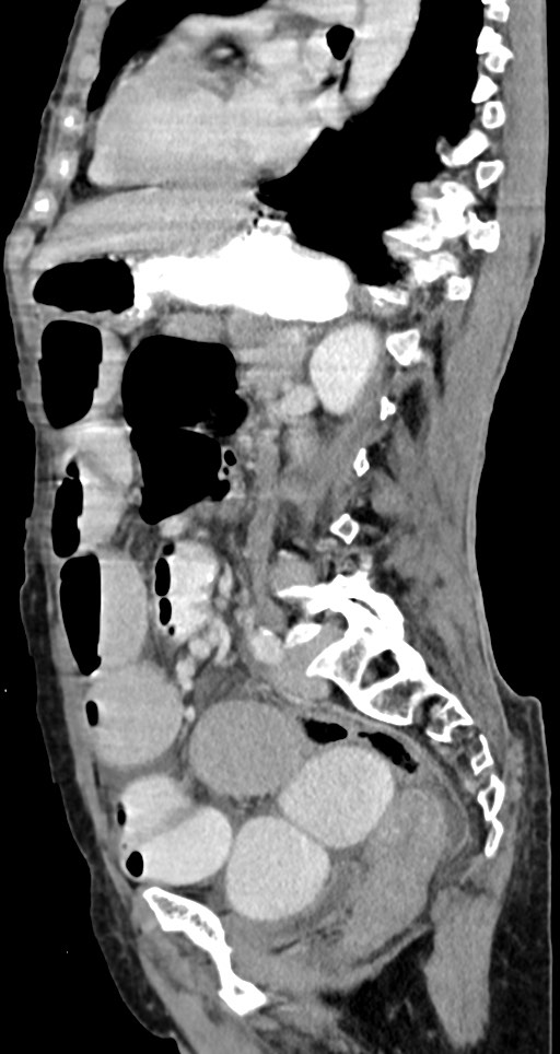 Acute small bowel (ileal) volvulus (Radiopaedia 71740-82139 Sagittal C+ portal venous phase 74).jpg