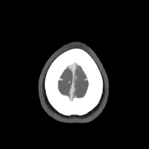 Acute subarachnoid hemorrhage and accessory anterior cerebral artery (Radiopaedia 69231-79009 D 67).jpg