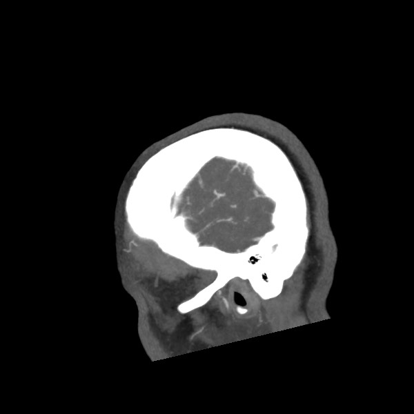 Acute subarachnoid hemorrhage and accessory anterior cerebral artery (Radiopaedia 69231-79009 Sagittal C+ arterial phase 10).jpg