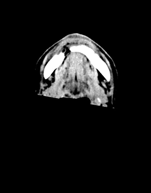 Acute superior cerebellar artery territory infarct (Radiopaedia 84104-99359 Axial non-contrast 83).jpg