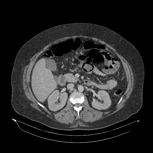 File:Acute superior mesenteric artery occlusion (Radiopaedia 51288-56960 Axial C+ portal venous phase 40).jpg