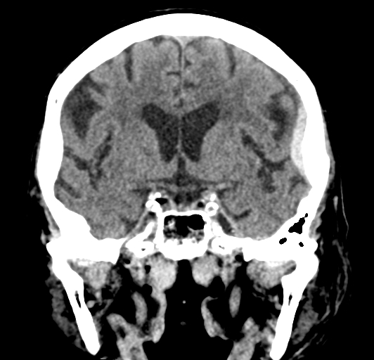 File:Acute traumatic subdural hematoma (Radiopaedia 82921-97257 Coronal non-contrast 42).jpg
