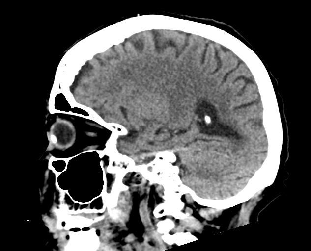 Acute traumatic subdural hematoma (Radiopaedia 82921-97257 Sagittal non-contrast 28).jpg