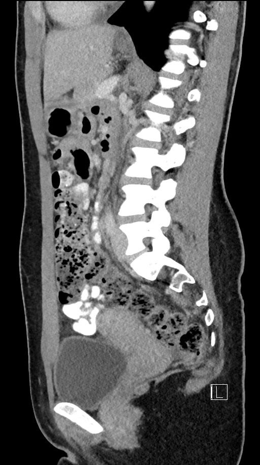 Acute uncomplicated appendicitis (Radiopaedia 61374-69304 Sagittal C+ portal venous phase 45).jpg