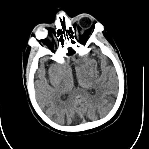 File:Acute vertebrobasilar ischemic infarction (Radiopaedia 25220-25473 Axial non-contrast 28).jpg