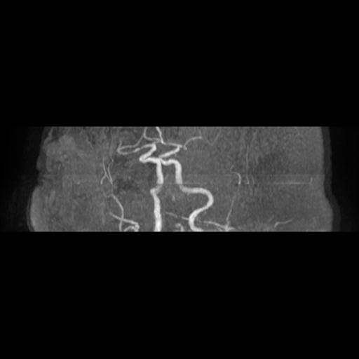 File:Acute vertebrobasilar ischemic infarction (Radiopaedia 25220-25474 Axial MRA 6).jpg