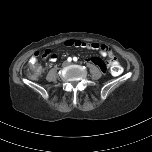 Adenocarcinoma of cecum (Radiopaedia 59222-66549 Axial C+ arterial phase 95).jpg