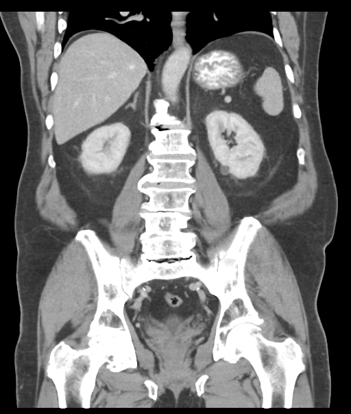 Adenocarcioma of rectum- T1 lesion (Radiopaedia 36921-38547 Coronal C+ portal venous phase 41).png