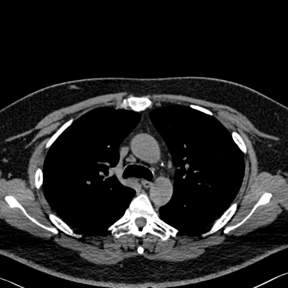Adenoid cystic carcinoma of the trachea (Radiopaedia 49042-54137 Axial non-contrast 116).jpg