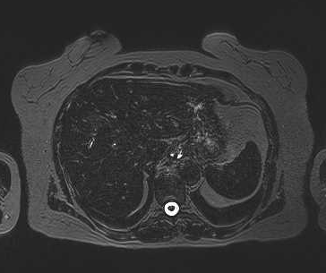 File:Adenomyomatosis of the gallbladder (Radiopaedia 50246-55587 Axial 106).png