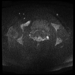File:Adenomyosis-scar endometriosis (Radiopaedia 65863-75022 Axial DWI 15).jpg
