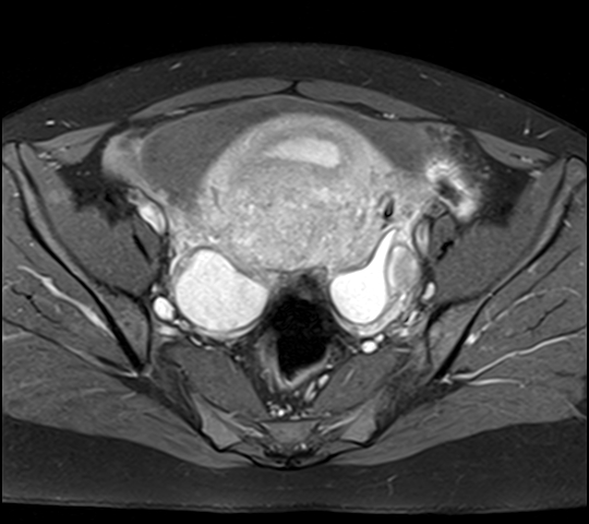 File:Adenomyosis - ovarian endometriomas (Radiopaedia 67031-76350 Axial T1 C+ fat sat 13).jpg