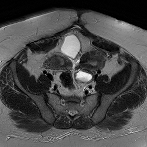 File:Adenomyosis within a didelphys uterus (Radiopaedia 70175-80215 Axial T2 12).jpg