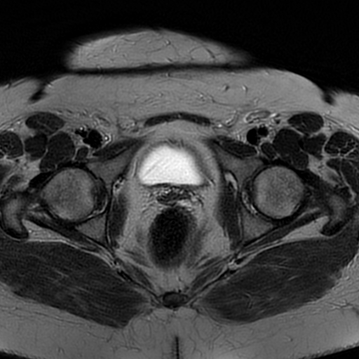 File:Adenomyosis within a didelphys uterus (Radiopaedia 70175-80215 Axial T2 28).jpg