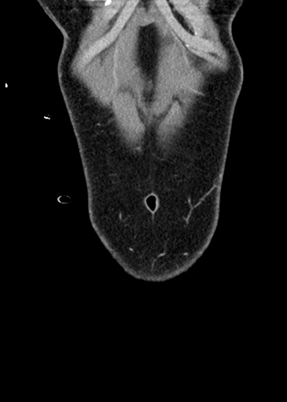 Adhesional small bowel obstruction (Radiopaedia 48397-53305 Coronal C+ portal venous phase 28).jpg