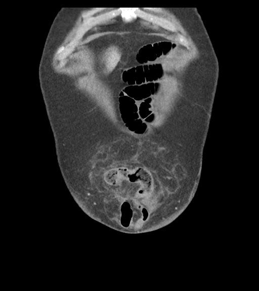 Adhesions within abdominal wall hernia (Radiopaedia 58283-65394 Coronal C+ portal venous phase 11).png