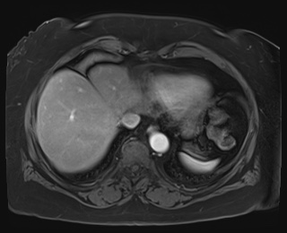 File:Adrenal cortical carcinoma (Radiopaedia 64017-72770 I 7).jpg