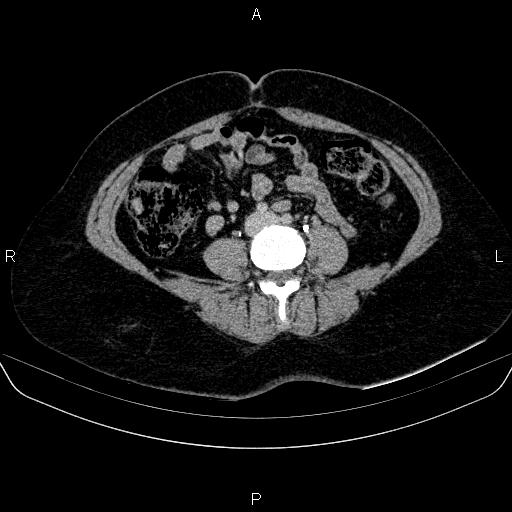 Adrenal cortical carcinoma (Radiopaedia 84882-100379 Axial C+ delayed 56).jpg