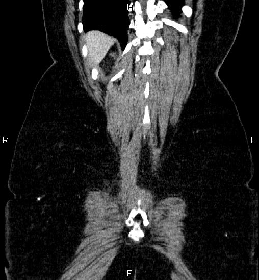 Adrenal cortical carcinoma (Radiopaedia 84882-100379 Coronal C+ portal venous phase 59).jpg