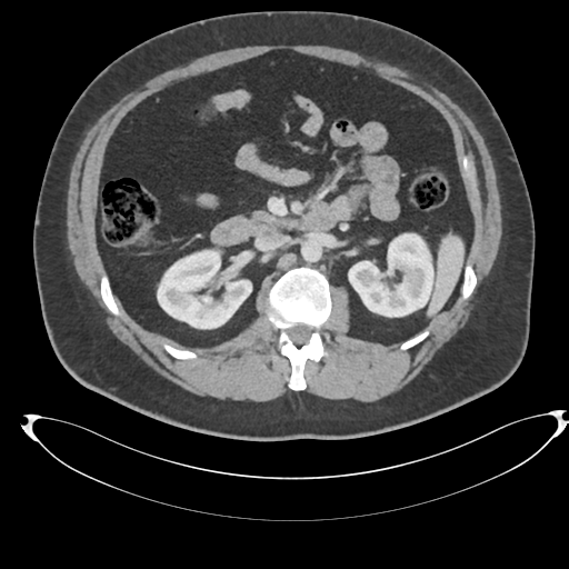 Adrenal cyst (Radiopaedia 45625-49778 AXIAL THICK 60 sec 34).png