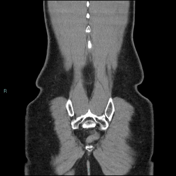 Adrenal cystic lymphangioma (Radiopaedia 83161-97534 Coronal C+ portal venous phase 72).jpg