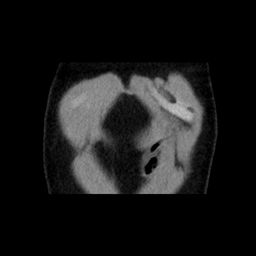 Adrenal gland trauma (Radiopaedia 81351-95079 Coronal non-contrast 12).jpg