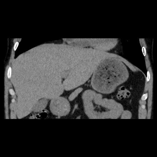 Adrenal gland trauma (Radiopaedia 81351-95079 Coronal non-contrast 32).jpg