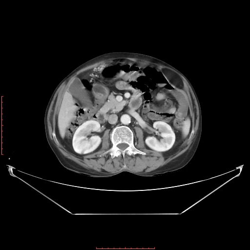 Adrenal hemangioma (Radiopaedia 68923-78668 Axial C+ portal venous phase 33).jpg