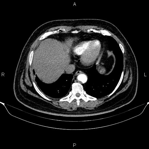 Adrenal hemorrhage (Radiopaedia 62622-70916 Axial C+ arterial phase 25).jpg