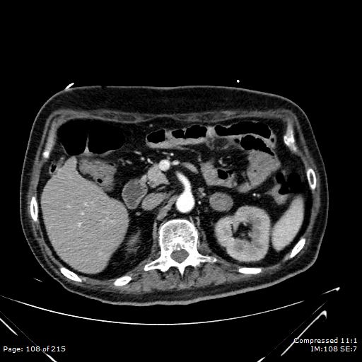 Adrenal metastasis (Radiopaedia 78425-91079 Axial C+ arterial phase 38).jpg