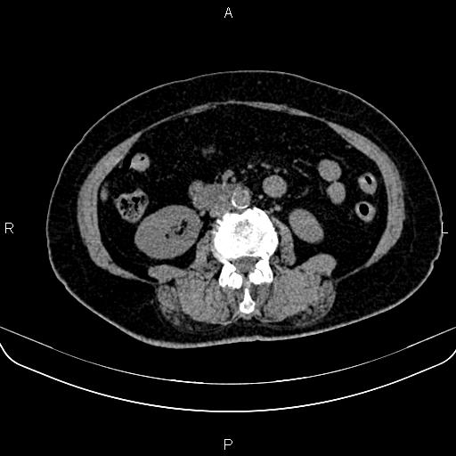 Adrenal myelolipoma (Radiopaedia 82742-96986 Axial non-contrast 83).jpg