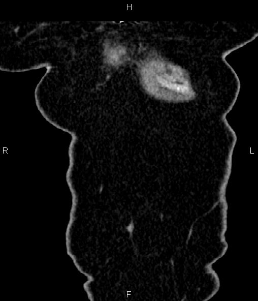 Adrenal myelolipoma (Radiopaedia 82742-96986 Coronal renal cortical phase 7).jpg