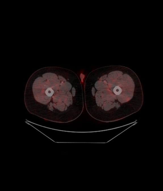 Adrenocortical carcinoma (Radiopaedia 80134-93440 ِAxial 296).jpg