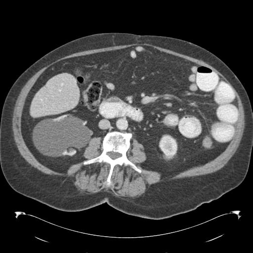 Adult ileal intussusception with secondary obstruction (Radiopaedia 30395-31051 Axial C+ portal venous phase 39).jpg