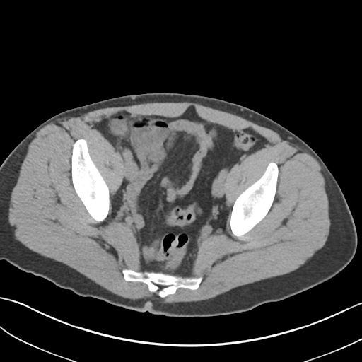 File:Adult polycystic kidney disease (Radiopaedia 47866-52626 Axial non-contrast 71).png