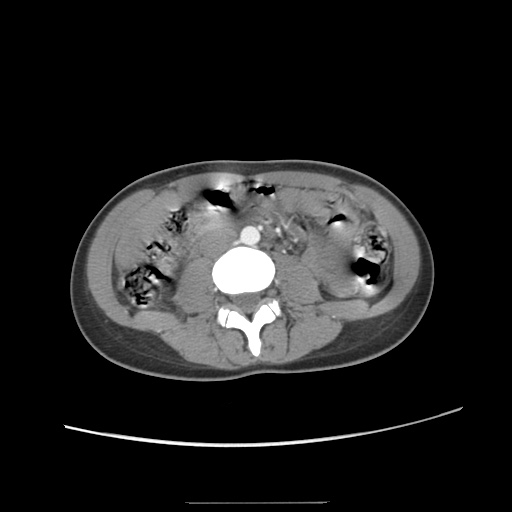Adult polycystic kidney disease (Radiopaedia 48845-53876 Axial renal cortical phase 37).jpg