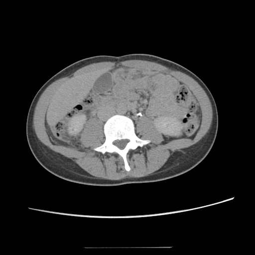 Adult polycystic kidney disease (Radiopaedia 48845-53876 Axial renal excretory phase 52).jpg