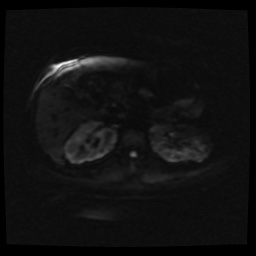 Adult polycystic kidney disease (Radiopaedia 59075-66365 Axial DWI 54).jpg