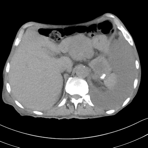 Advanced metastatic lung cancer (Radiopaedia 48910-53954 Axial non-contrast 58).png