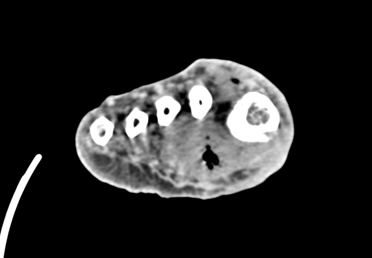 Advanced osteomyelitis due to open metatarsal fracture (Radiopaedia 83891-99095 Axial non-contrast 36).jpg