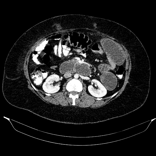 Afferent loop syndrome - secondary to incarcerated trocar site hernia (Radiopaedia 82959-97305 Axial C+ portal venous phase 103).jpg