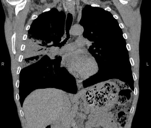 Air bronchogram in pneumonia (Radiopaedia 85719-101512 Coronal non-contrast 29).jpg