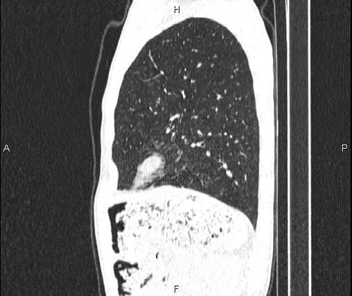 Air bronchogram in pneumonia (Radiopaedia 85719-101512 Sagittal lung window 76).jpg