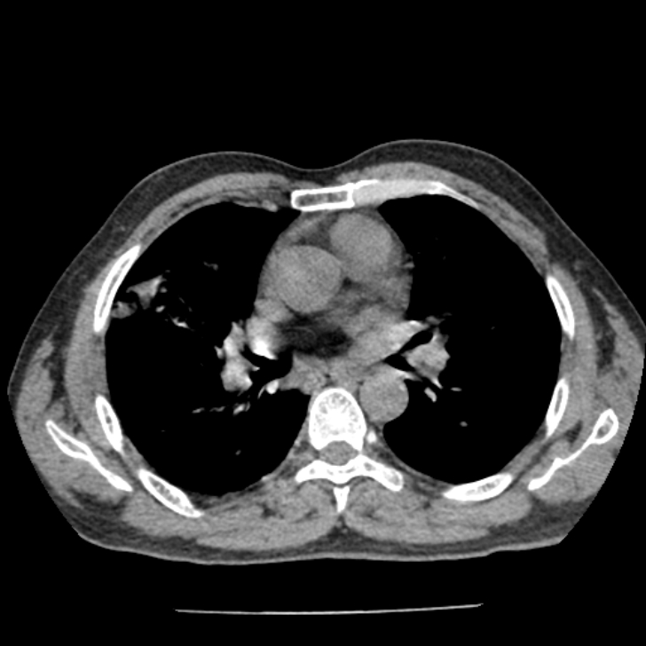 Airway foreign body in adult (Radiopaedia 85907-101779 Axial liver window 81).jpg