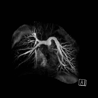 File:Alagille syndrome with pulmonary hypertension (Radiopaedia 49384-54502 Coronal MRA 1).jpg