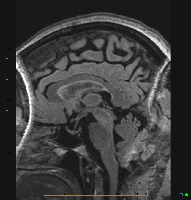 Aliasing artifact causing a spurious cerebellar lesion (Radiopaedia 48783-53810 Sagittal FLAIR 47).jpg