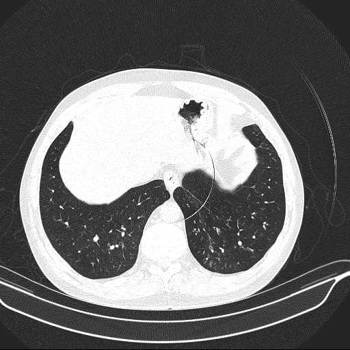 File:Allergic bronchopulmonary aspergillosis (Radiopaedia 21386-21320 Axial lung window 33).jpg