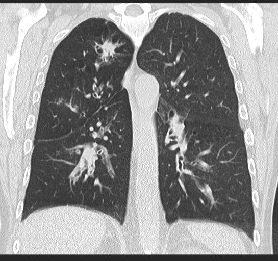 Allergic bronchopulmonary aspergillosis (Radiopaedia 44760-48571 Coronal lung window 37).png