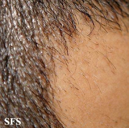 Alopecia Areata (Dermatology Atlas 51).jpg