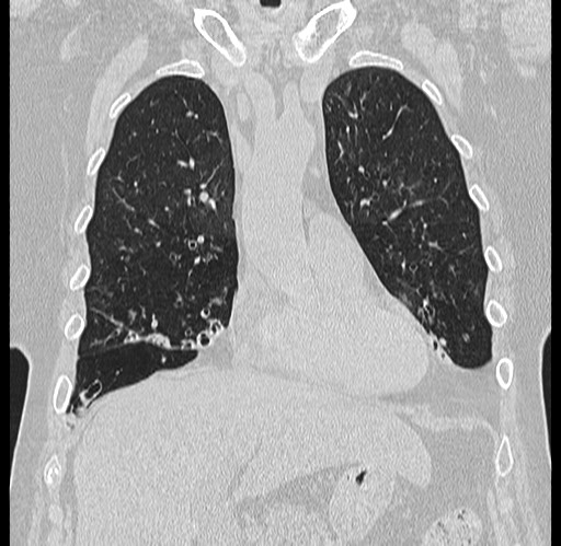 Alpha-1-antitrypsin deficiency (Radiopaedia 72058-82557 Coronal lung window 18).jpg